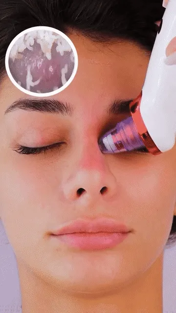 Removedor De Cravos Espinhas Cleaning Sugador Poros Acne Sucção Usb Recarregável