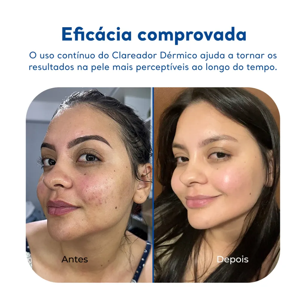 Creme Clareador - Cicatribem