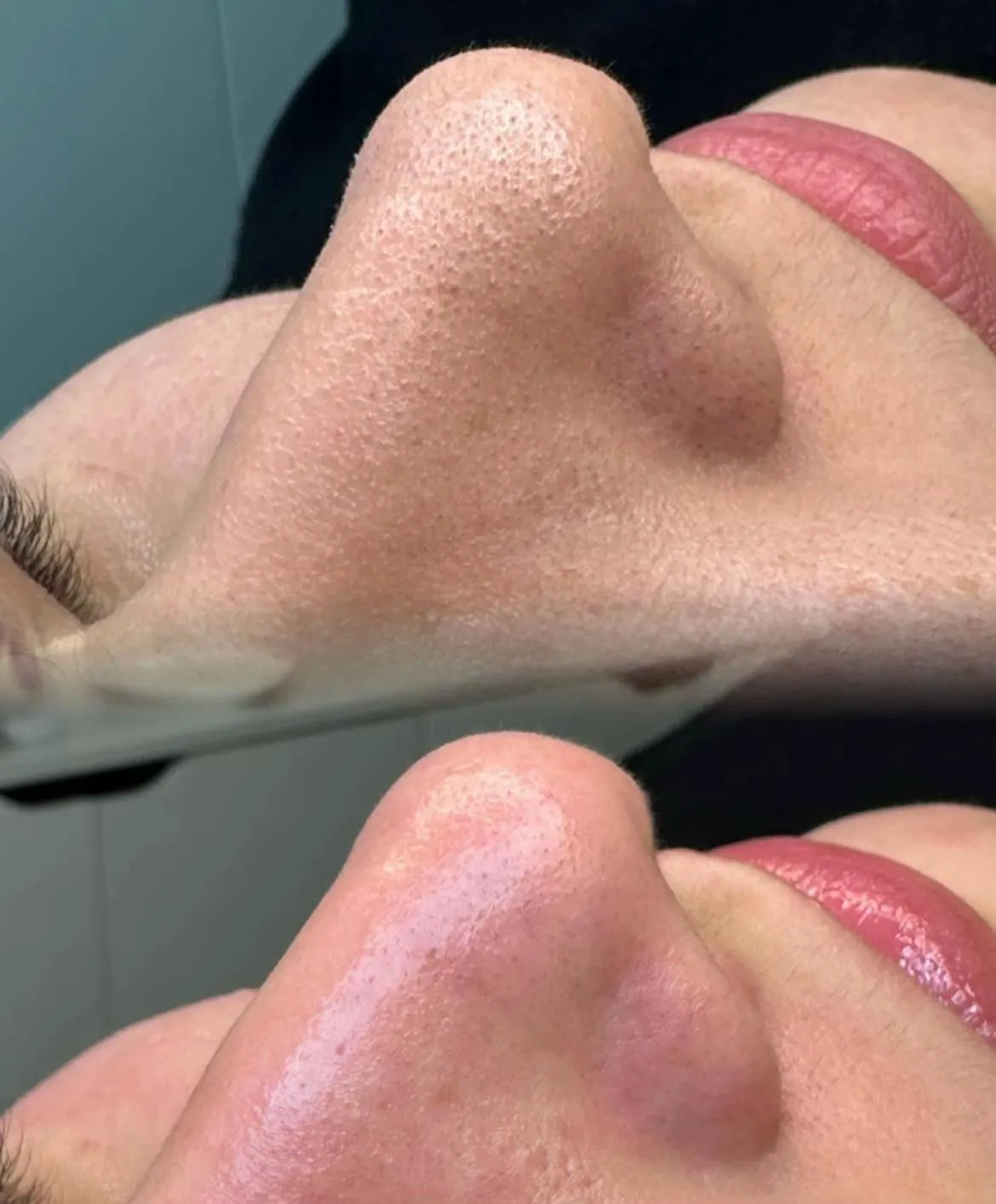 Removedor Cravos e Espinhas Extrator de Cravos Sucção a Vácuo Aparelho Recarregável Sugador Remove Acne